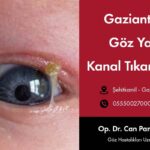 Gaziantep Göz Yaşı Kanal Tıkanıklığı